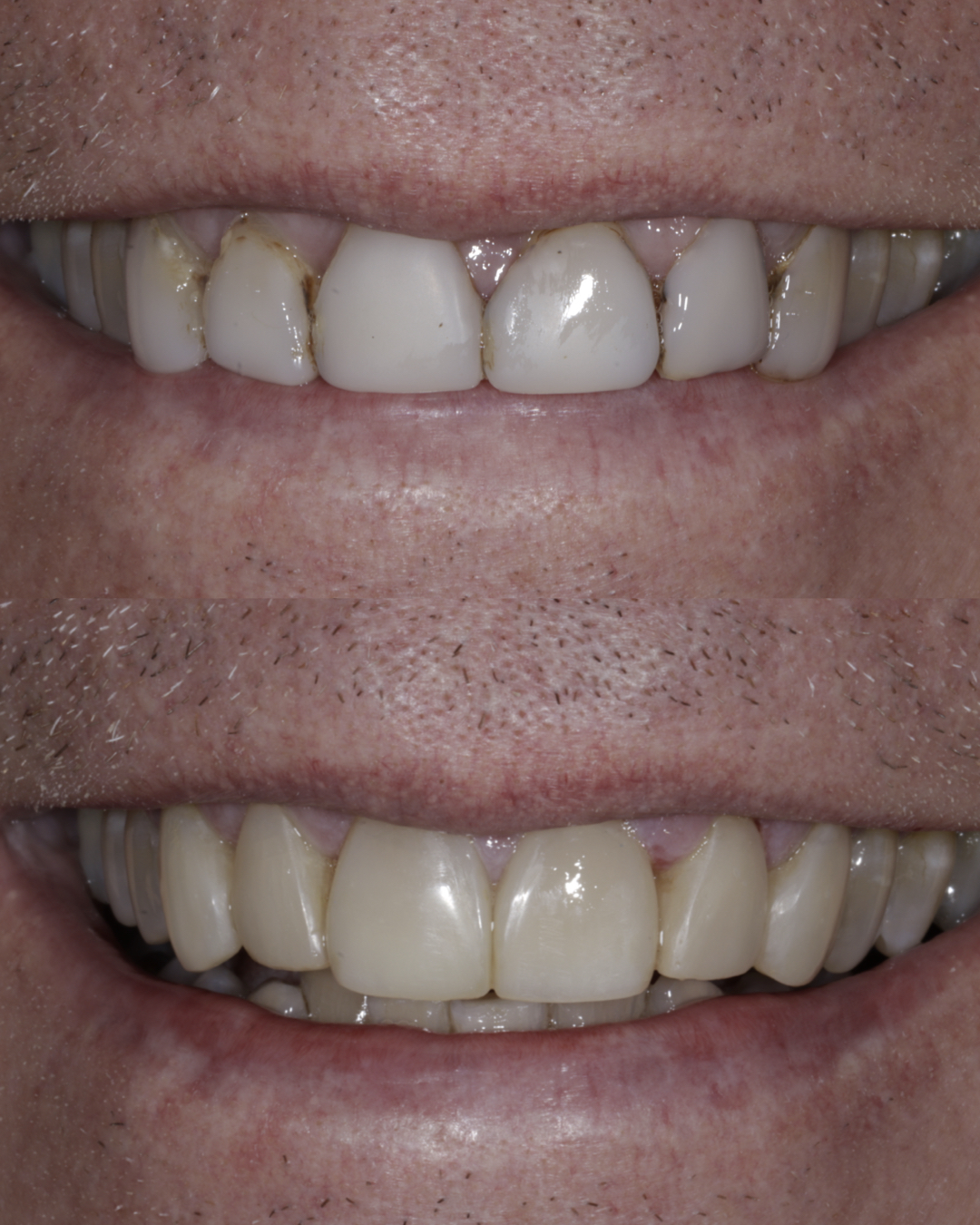 Before and after close-up comparison of a patient’s smile highlighting enhanced tooth alignment, symmetry, and overall cosmetic dental improvement – dentist williamsville ny