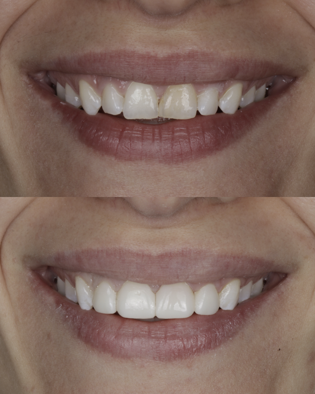 Before and after close-up comparison of a patient’s smile highlighting improved tooth color and alignment, representing cosmetic dental treatment outcomes – dentist williamsville ny