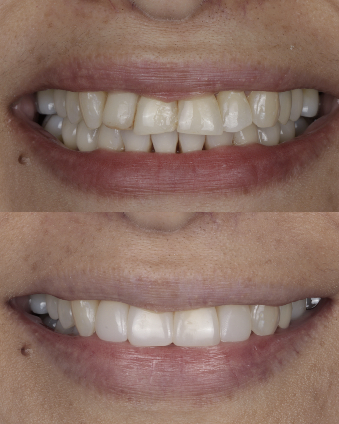 Before and after close-up comparison of a patient’s smile showing whiter, more even teeth, representing successful cosmetic dental treatment – dentist williamsville ny