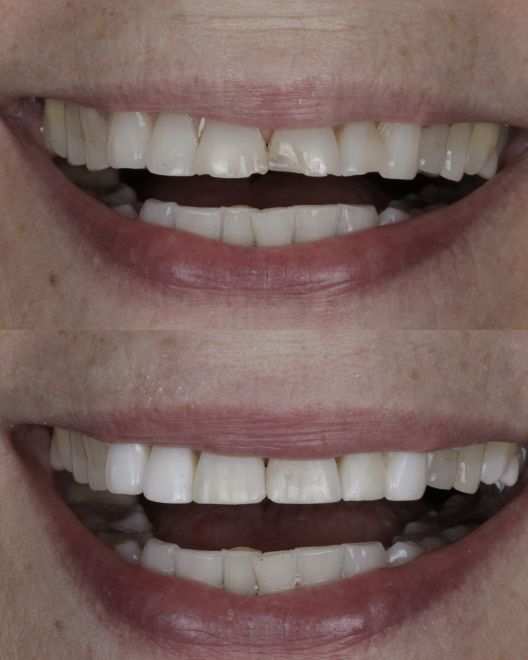 Before and after close-up of a patient’s smile showing enhanced tooth alignment and a brighter, more uniform appearance, representing cosmetic dentistry results – dentist williamsville ny