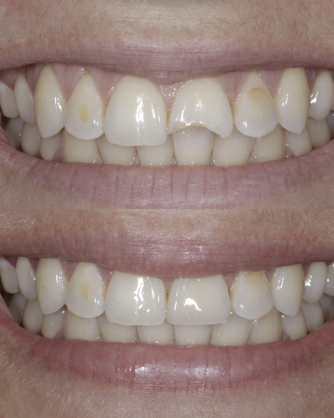 Before and after close-up comparison of a patient’s smile highlighting whiter, more uniform teeth and enhanced aesthetics from cosmetic dentistry – dentist williamsville ny