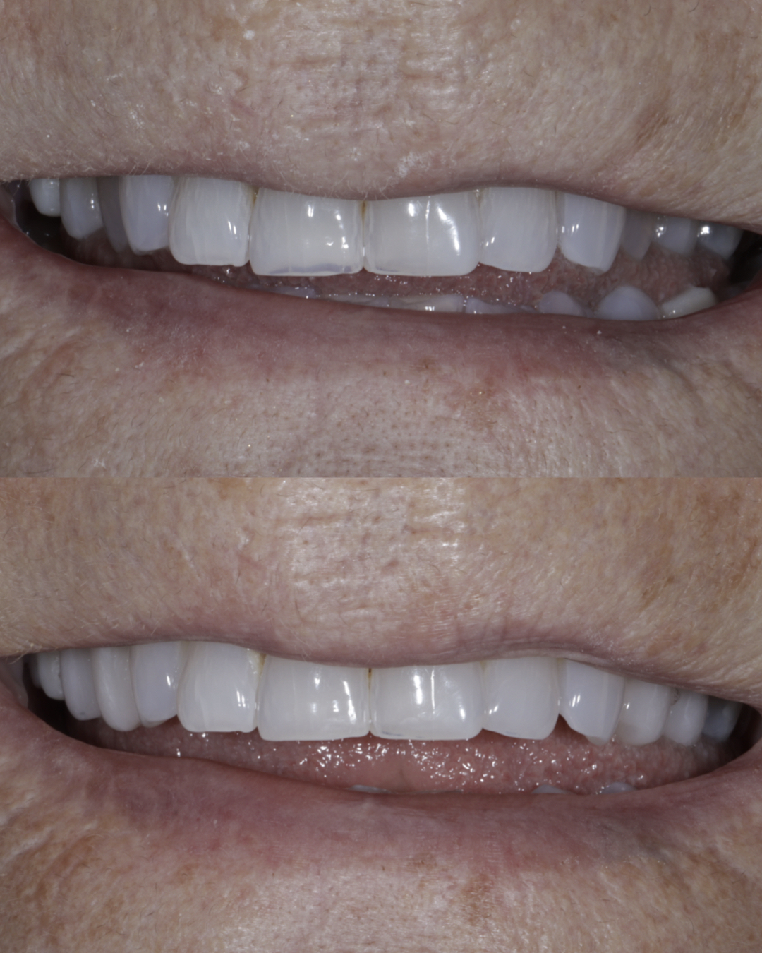Before and after close-up comparison of a patient’s smile highlighting smoother, whiter teeth and enhanced overall appearance from cosmetic dental treatment – dentist williamsville ny