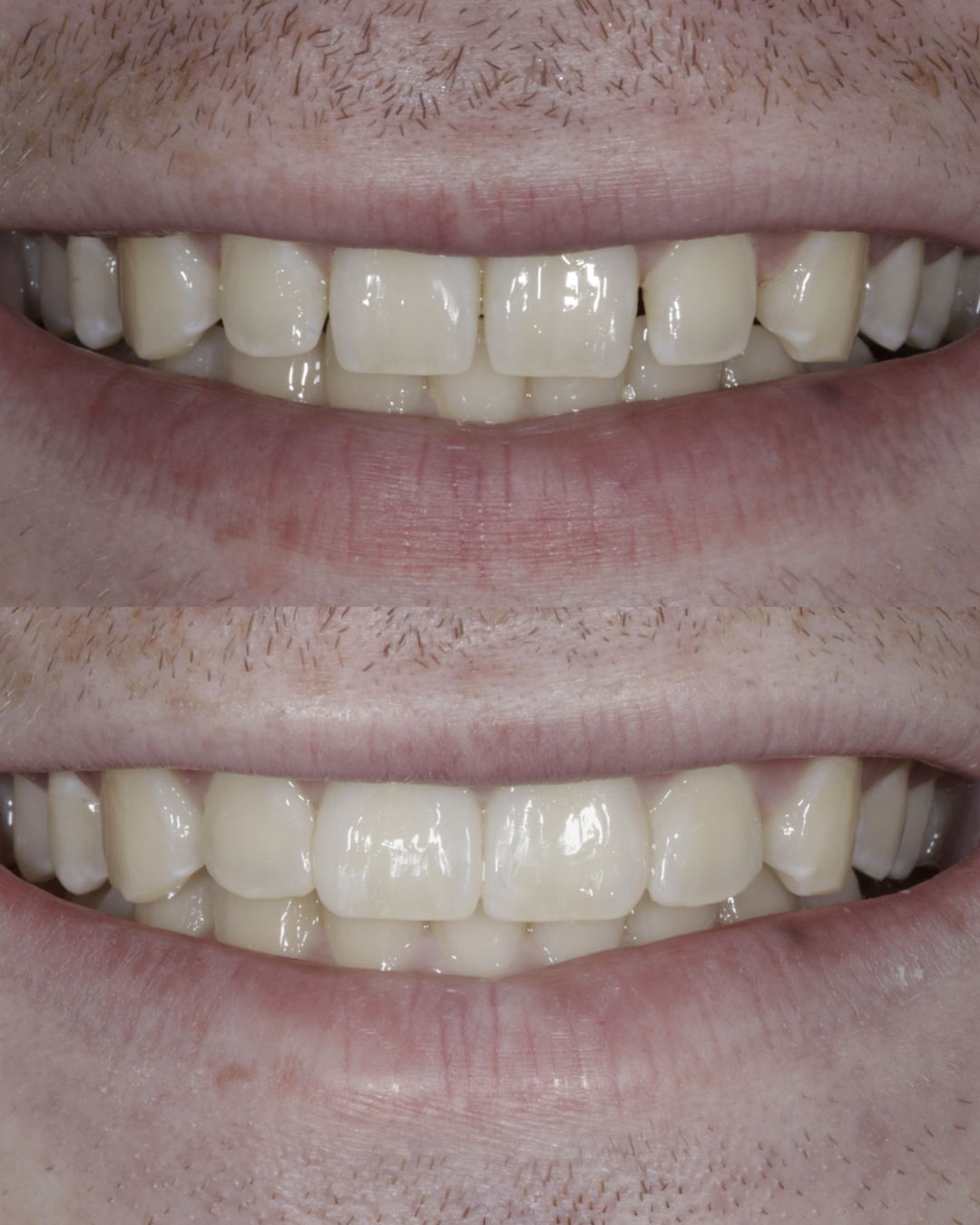 Before and after close-up comparison of a patient’s smile highlighting brighter, more even teeth and successful cosmetic dental treatment – dentist williamsville ny