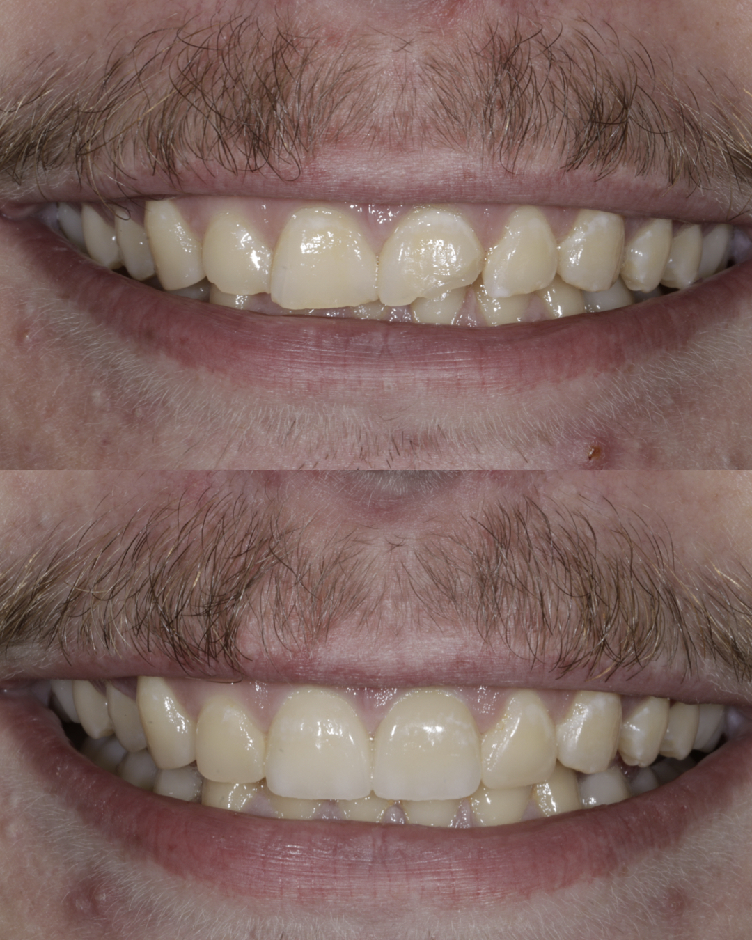 Before and after close-up comparison of a patient’s smile highlighting improved tooth brightness and overall cosmetic dental results – dentist williamsville ny