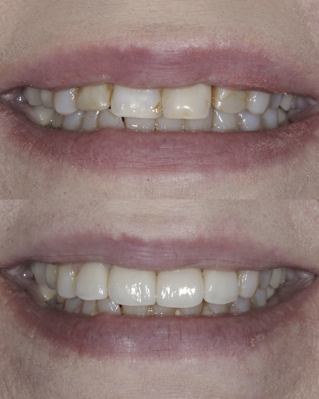 Before and after close-up comparison of a patient’s smile highlighting whiter, more uniform teeth and successful cosmetic dental treatment results – dentist williamsville ny