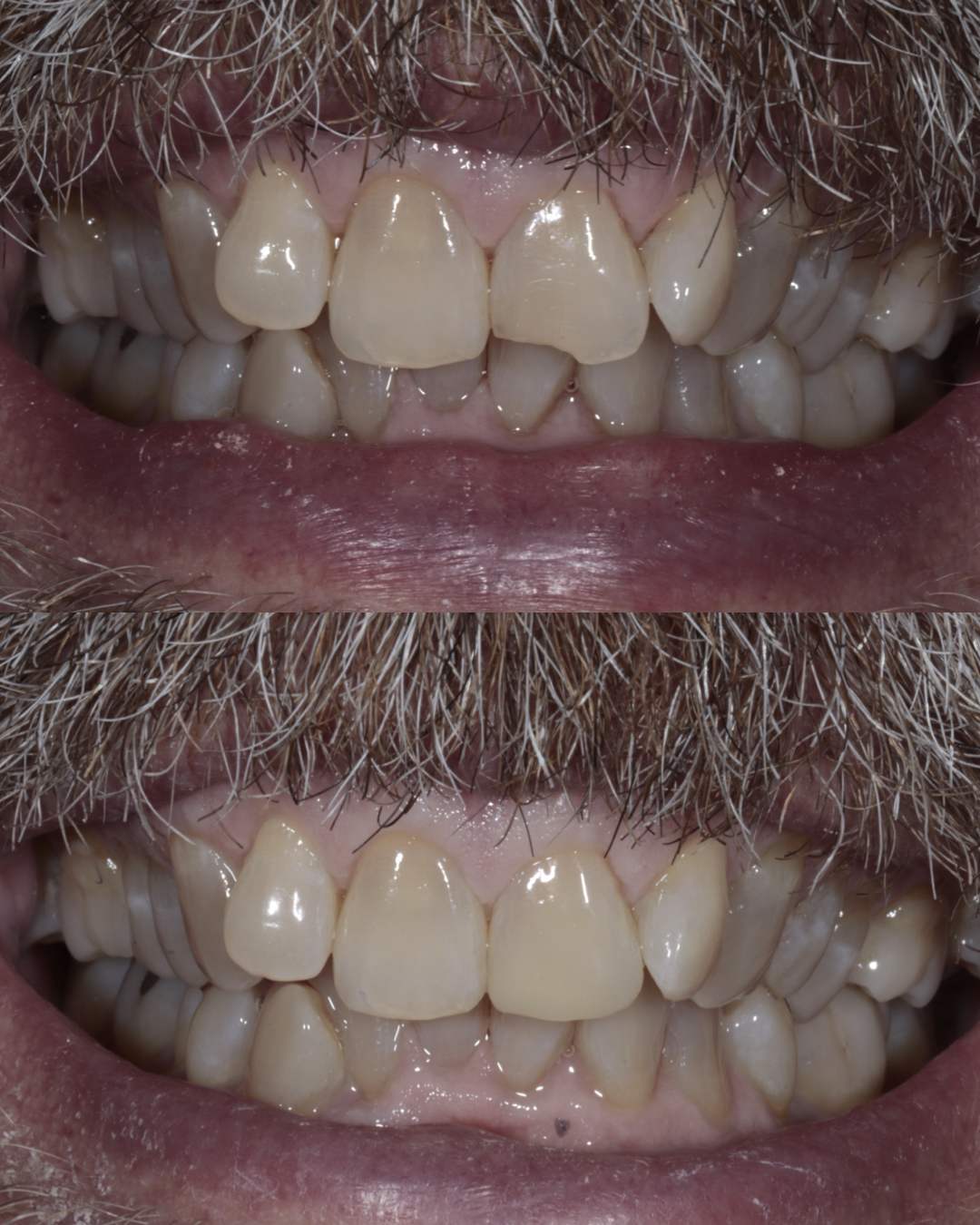 Before and after close-up comparison of a patient’s smile highlighting enhanced alignment, symmetry, and overall cosmetic dentistry results – dentist williamsville ny