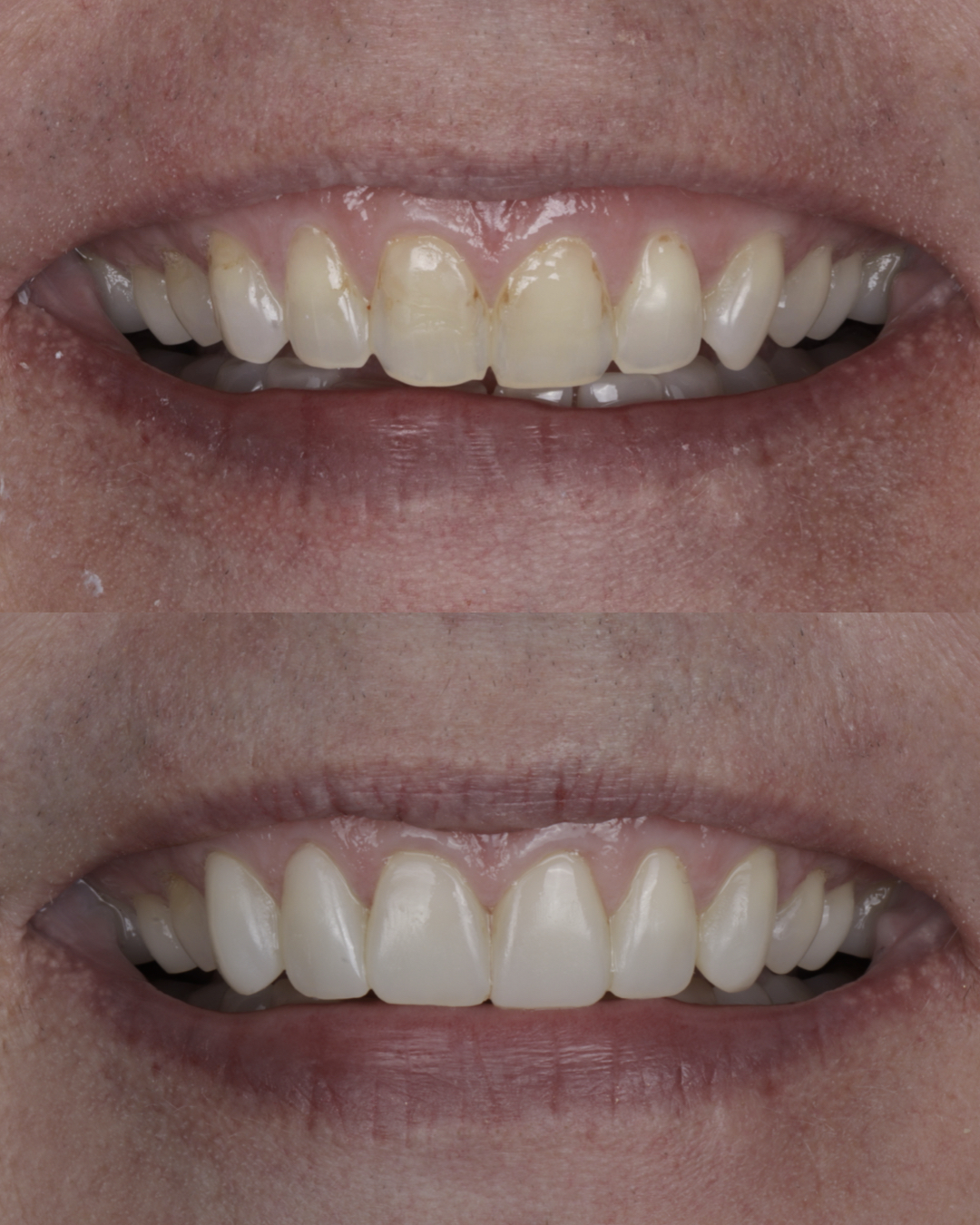 Before and after close-up comparison of a patient’s smile highlighting smoother, brighter teeth and successful cosmetic dental treatment results – dentist williamsville ny