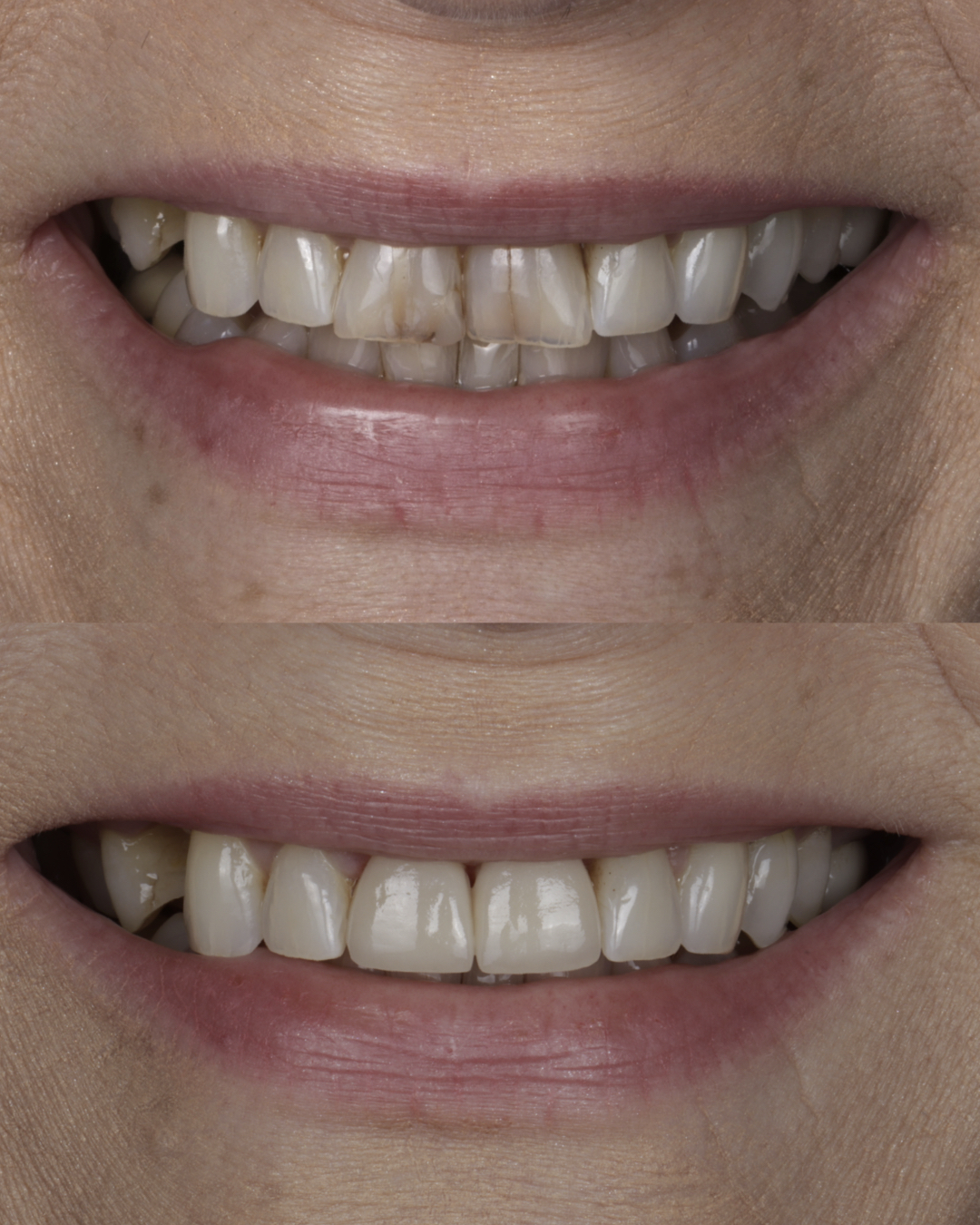 Before and after comparison of a patient’s smile highlighting improved tooth color, alignment, and overall aesthetic results from cosmetic dentistry – dentist williamsville ny