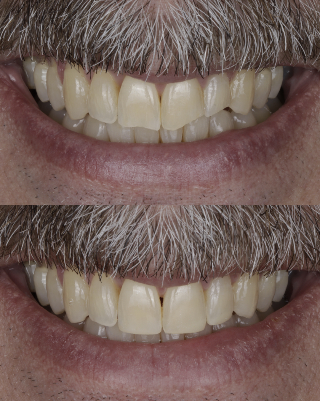 Before and after close-up of a patient’s smile highlighting cosmetic dental improvements with smoother, brighter, and more uniform teeth – dentist williamsville ny
