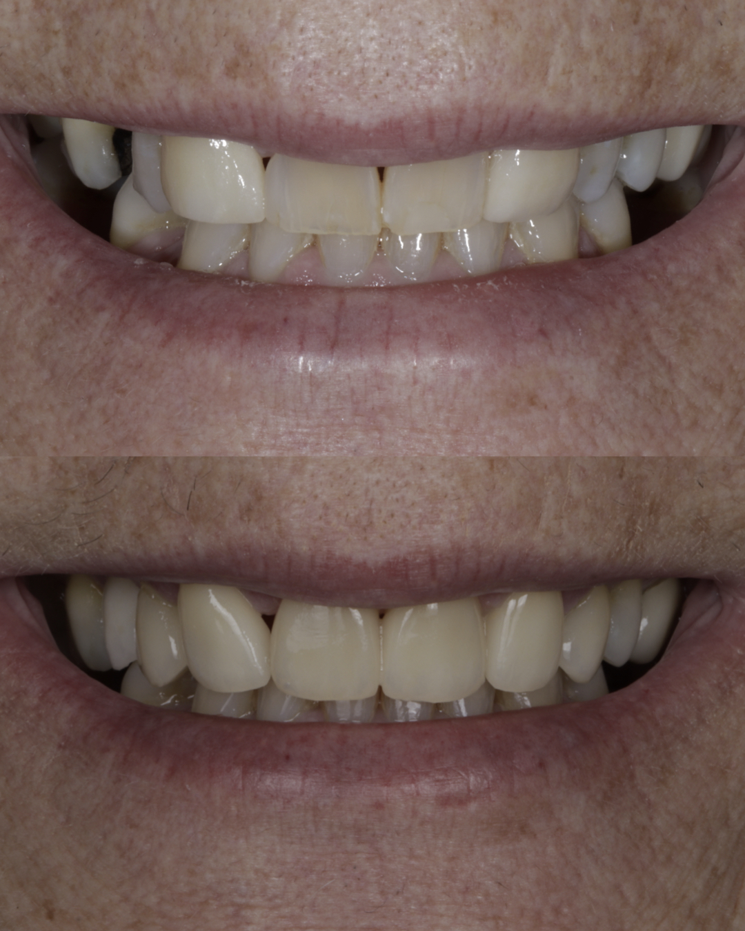 Before and after close-up of a patient’s smile showing cosmetic dental improvements with more even, natural-looking teeth – dentist williamsville ny