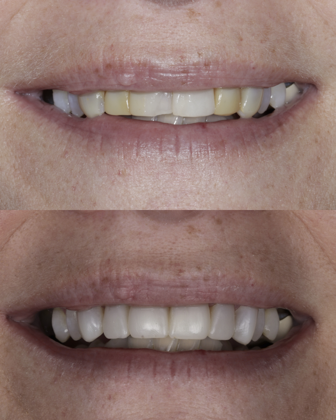 Before and after smile comparison highlighting cosmetic dental treatment with improved tooth color and symmetry – dentist williamsville ny