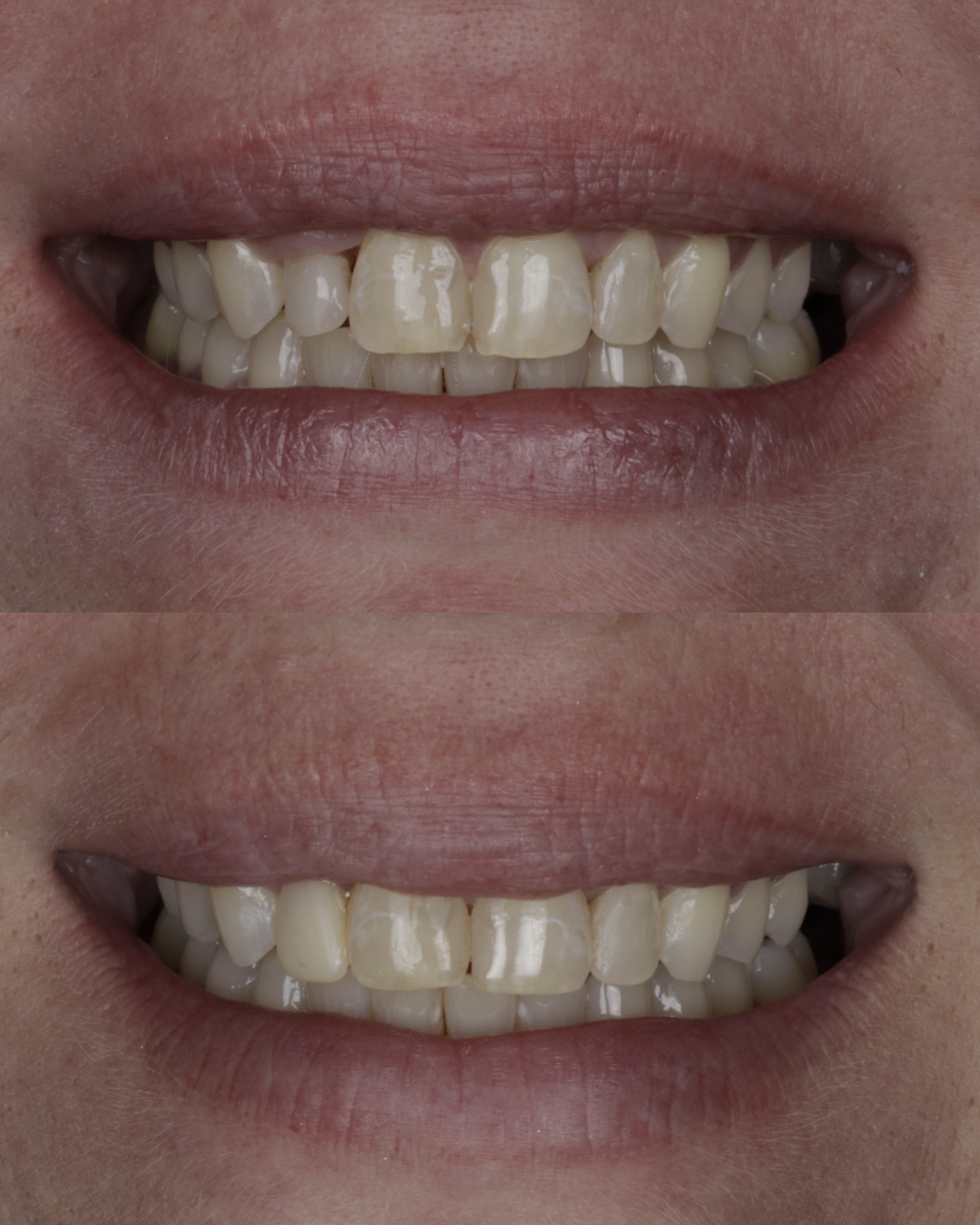 Before and after cosmetic dentistry results showing enhanced tooth shape and whiter smile appearance – dentist williamsville ny