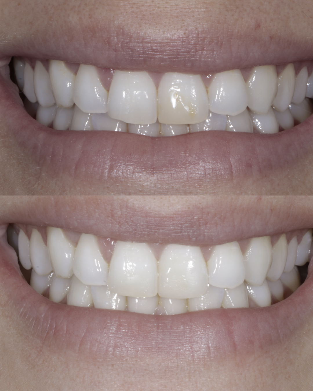 Before and after cosmetic dental treatment showing significantly whiter, more uniform teeth – dentist williamsville ny