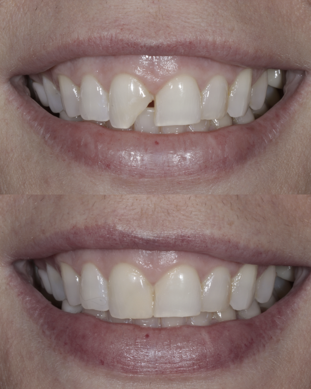 Before and after smile comparison showing repaired chipped tooth and improved symmetry with dental bonding – dentist williamsville ny
