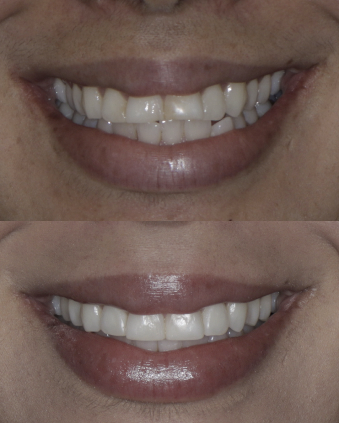 Before and after dental treatment showing brighter teeth and improved overall smile appearance – dentist williamsville ny