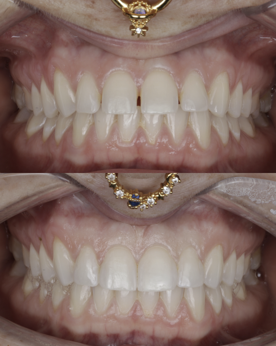 Before and after cosmetic dental results showing a more even, brighter smile after treatment – dentist williamsville ny