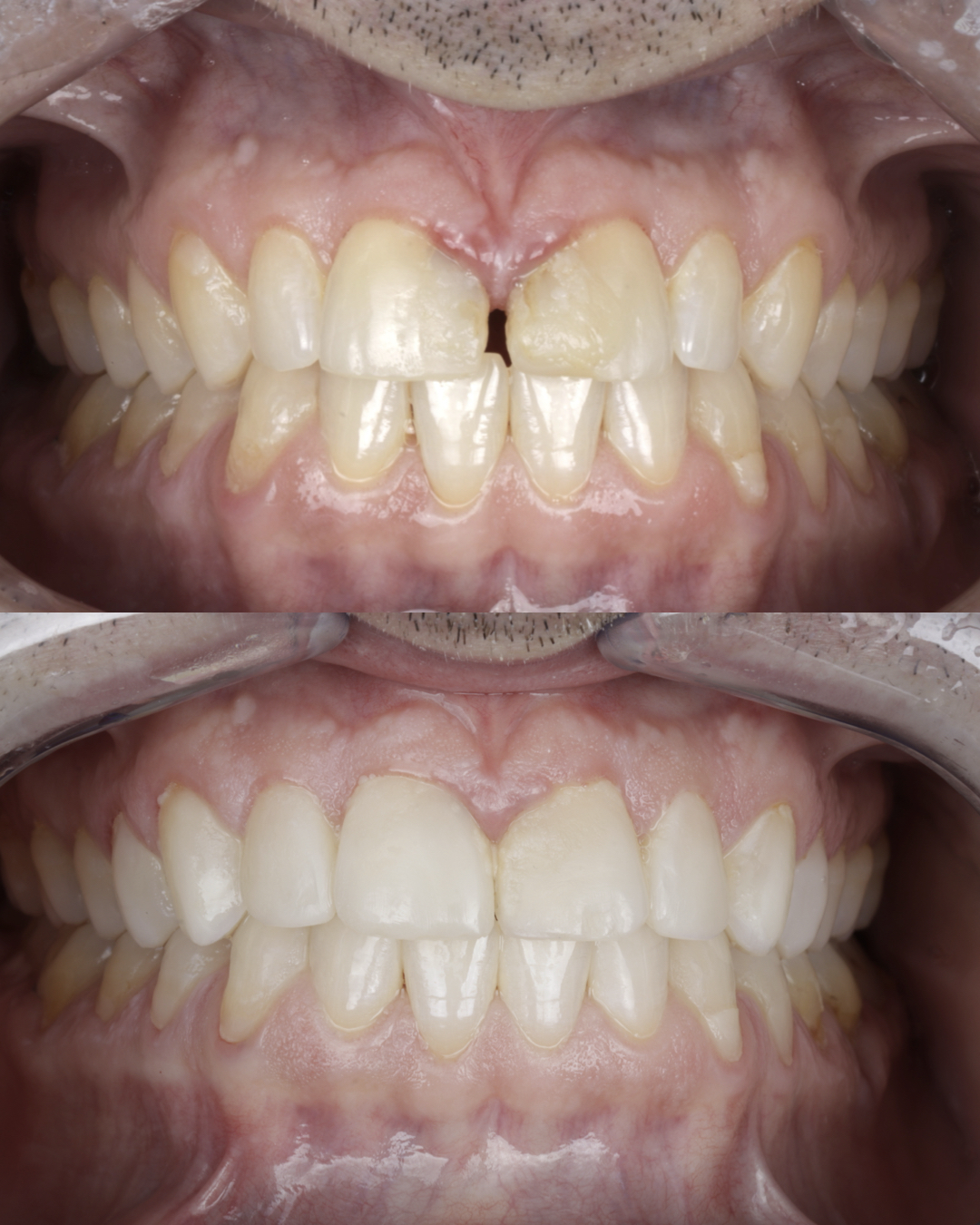 Before and after smile makeover showing whiter, straighter teeth and improved overall appearance – dentist williamsville ny